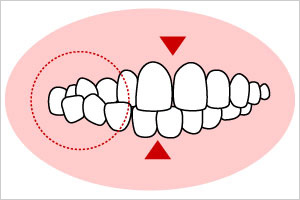 交叉咬合(こうさこうごう)